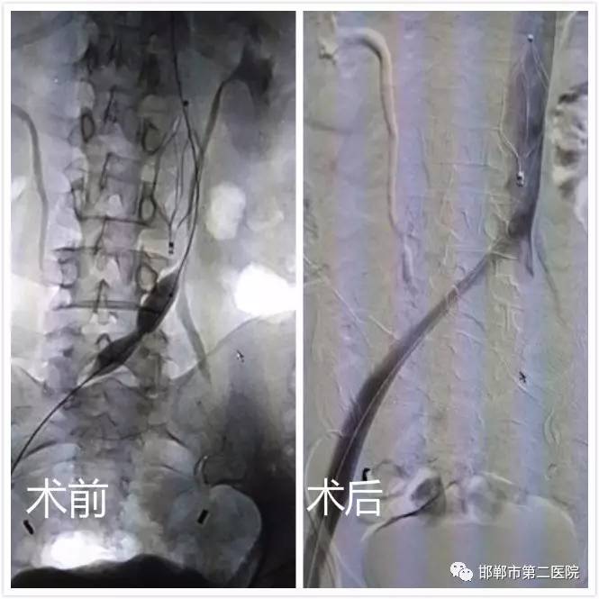 微创介入导管取栓治愈一例下肢肿胀痛髂静脉血栓症