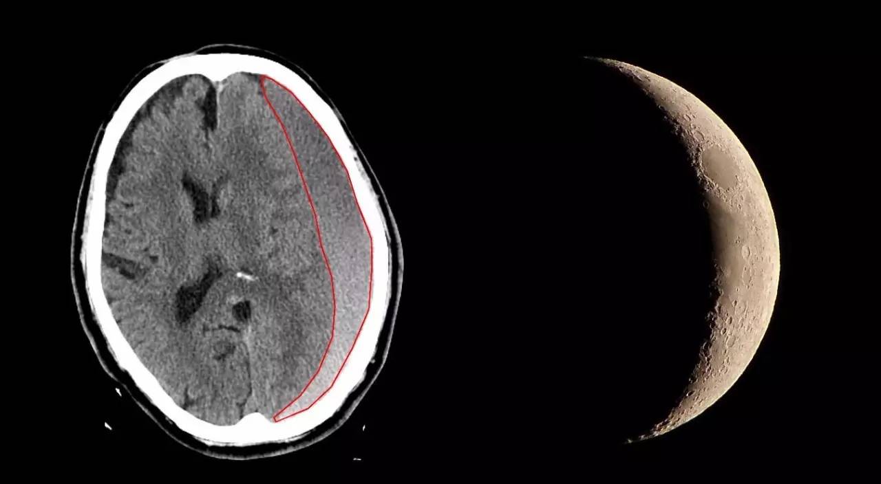 头颅ct竟照出"新月"形状.老年人,千万要当心头部