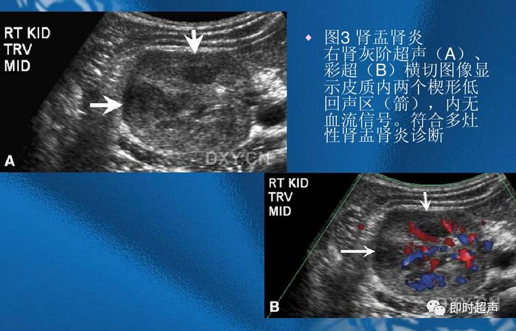 肾脏感染性疾病的超声诊断