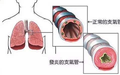 慢性支气管炎，艾灸这5个穴位就够了 .艾灸养生