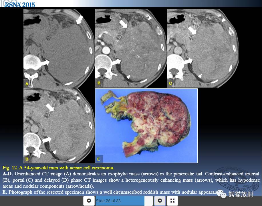 rsna精彩幻灯丨胰腺肿瘤who分类实性肿瘤及肿瘤样病变的影像表现双语