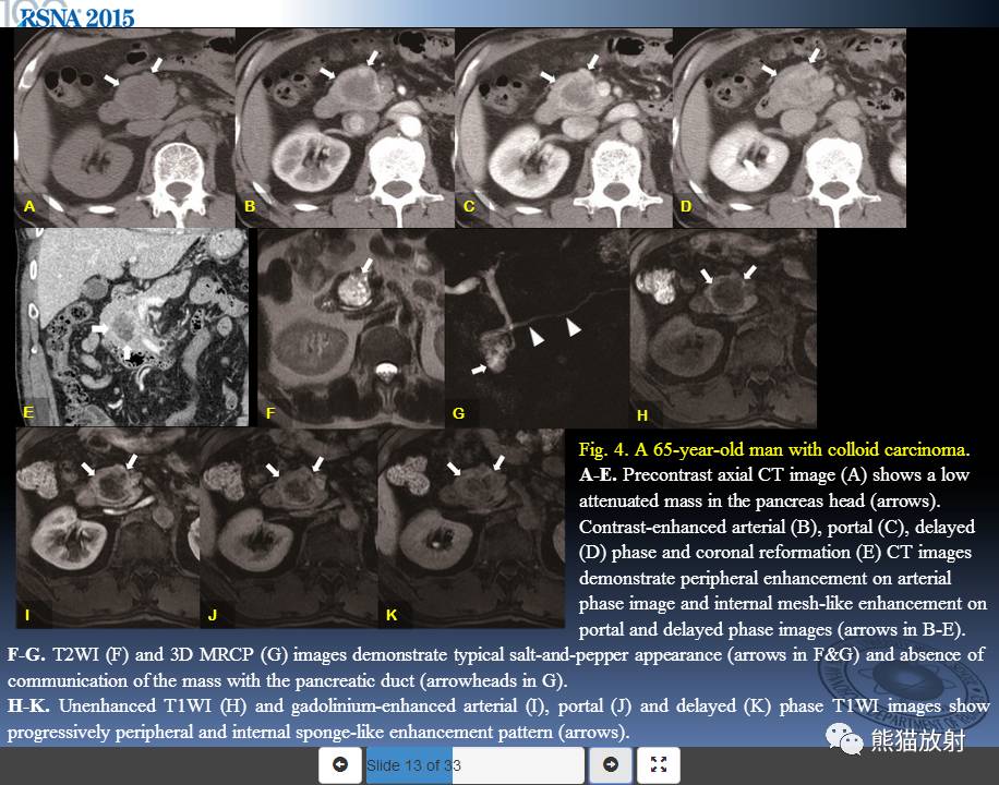 rsna精彩幻灯丨胰腺肿瘤who分类实性肿瘤及肿瘤样病变的影像表现双语