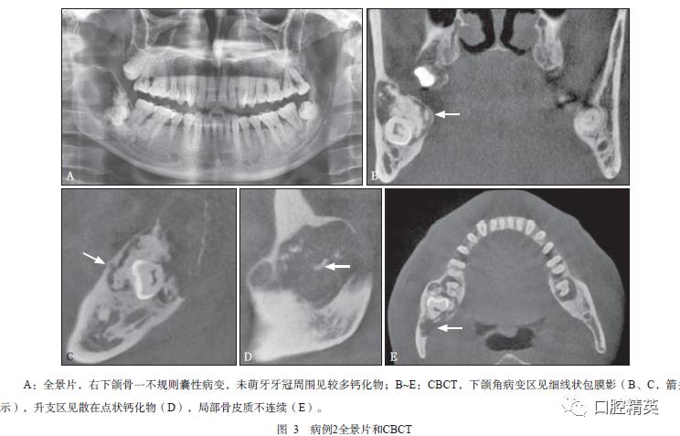 全景片示右下颌骨体后份自47至右下颌升支见一不规则的囊性病变,边界