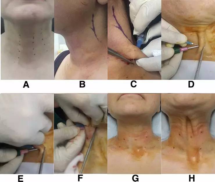 医美圈 | 新方法分享:使用18g针头切割颈阔肌带行颈部
