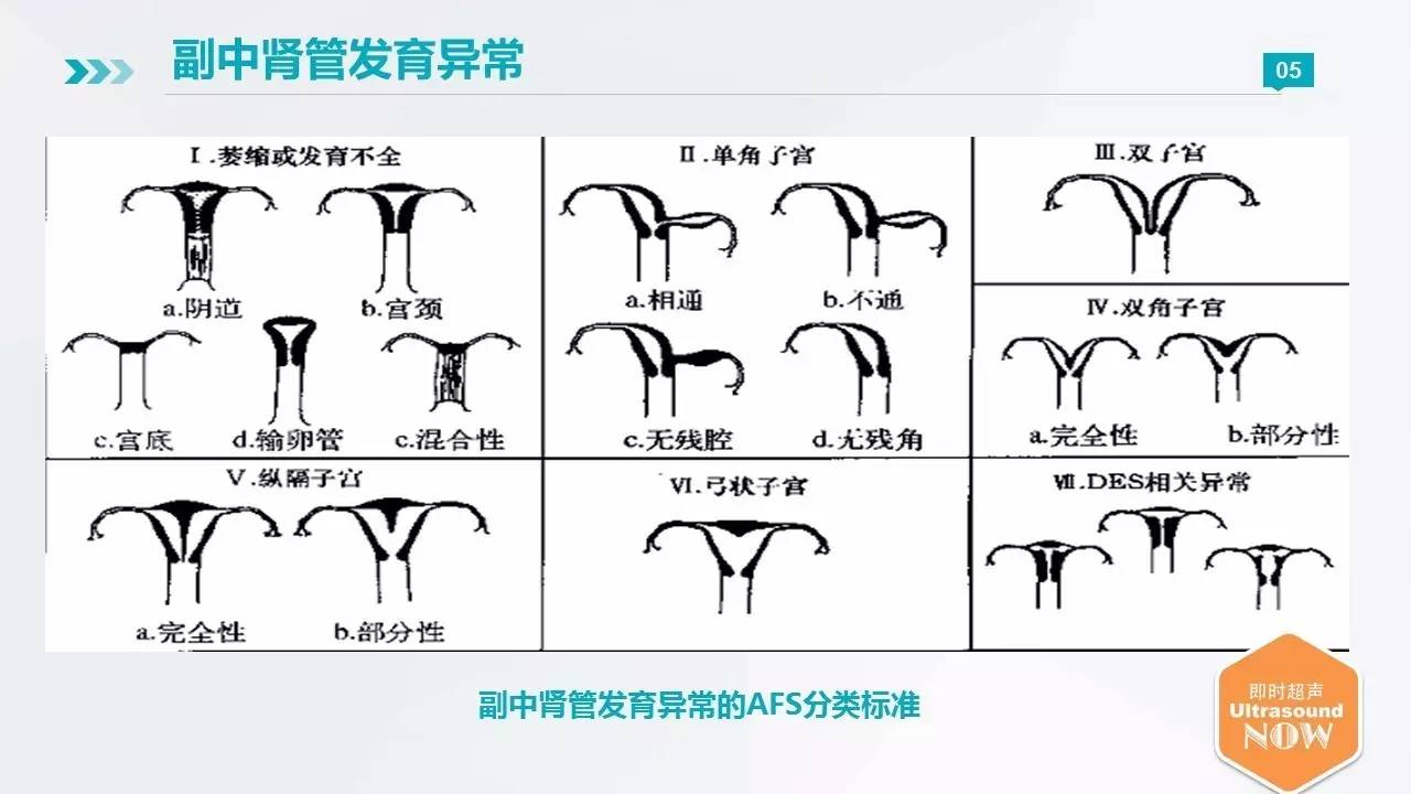 【免费直播】先天性子宫畸形的超声诊断