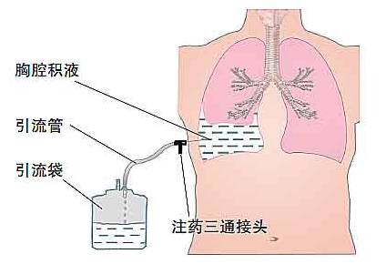 胸腔置管闭式引流示意图