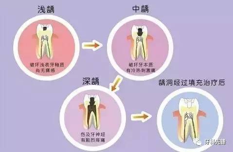 第一次根管治疗,原来这些地方要注意.