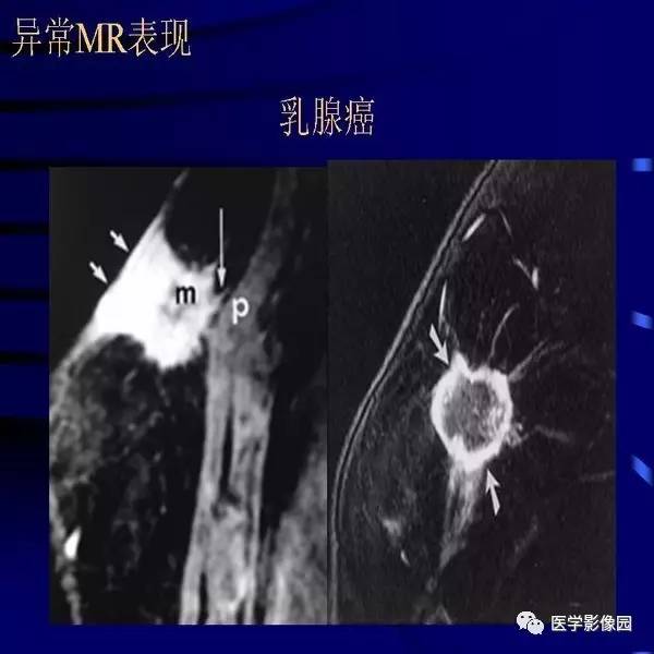 乳腺mri诊断要点丨影像天地