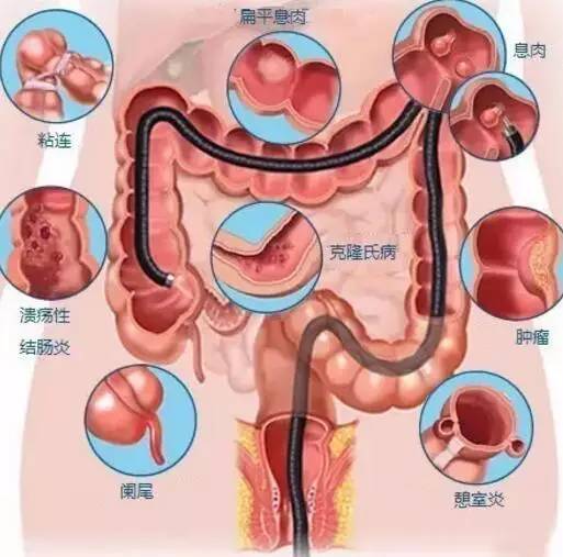出现什么症状时需做胃镜及肠镜检查?