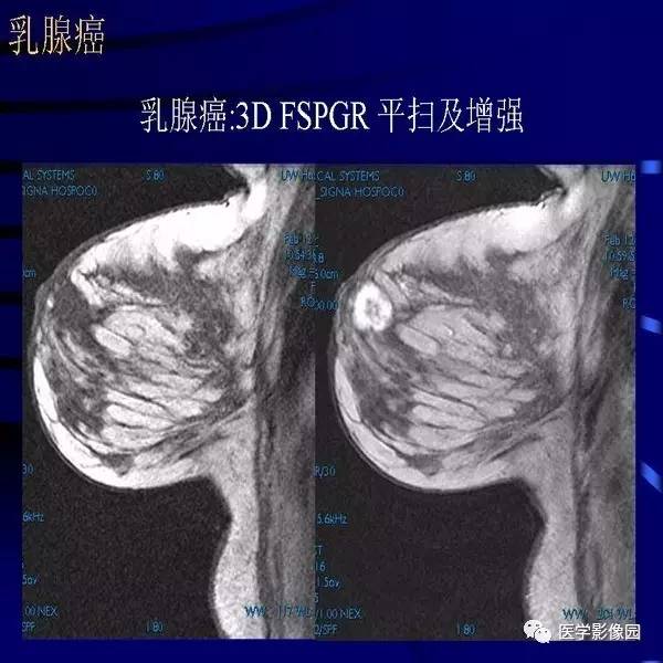 乳腺mri诊断要点丨影像天地