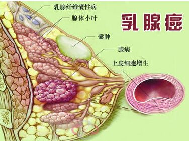 【长沙中山妇科:女性为什么得乳腺癌的10大误区