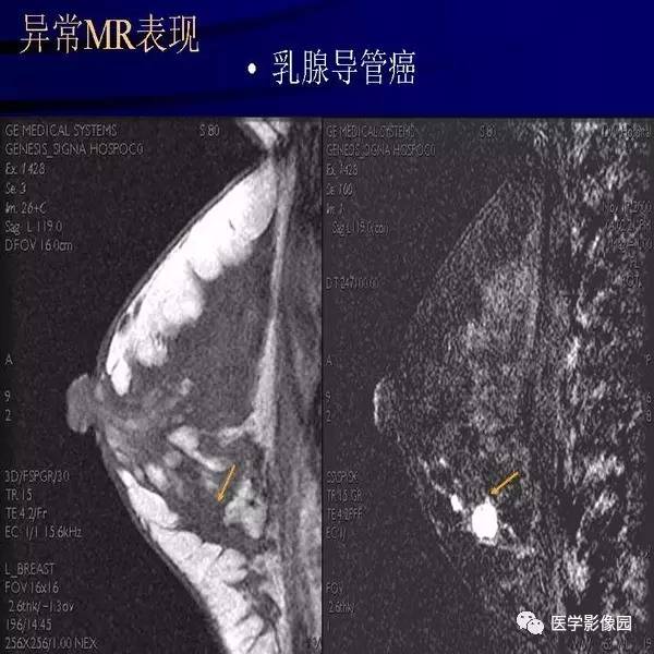 乳腺mri诊断要点丨影像天地