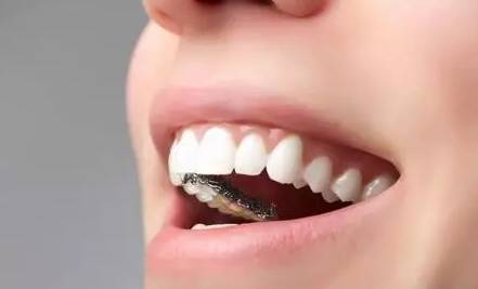 舌侧隐形矫正特点 针对高难度矫牙 "隐形"效果 不损伤牙面