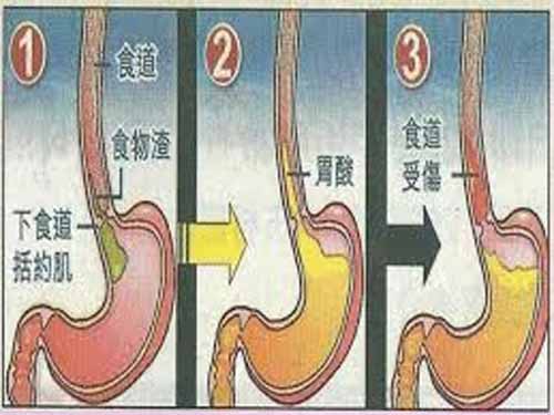 食道图片高清