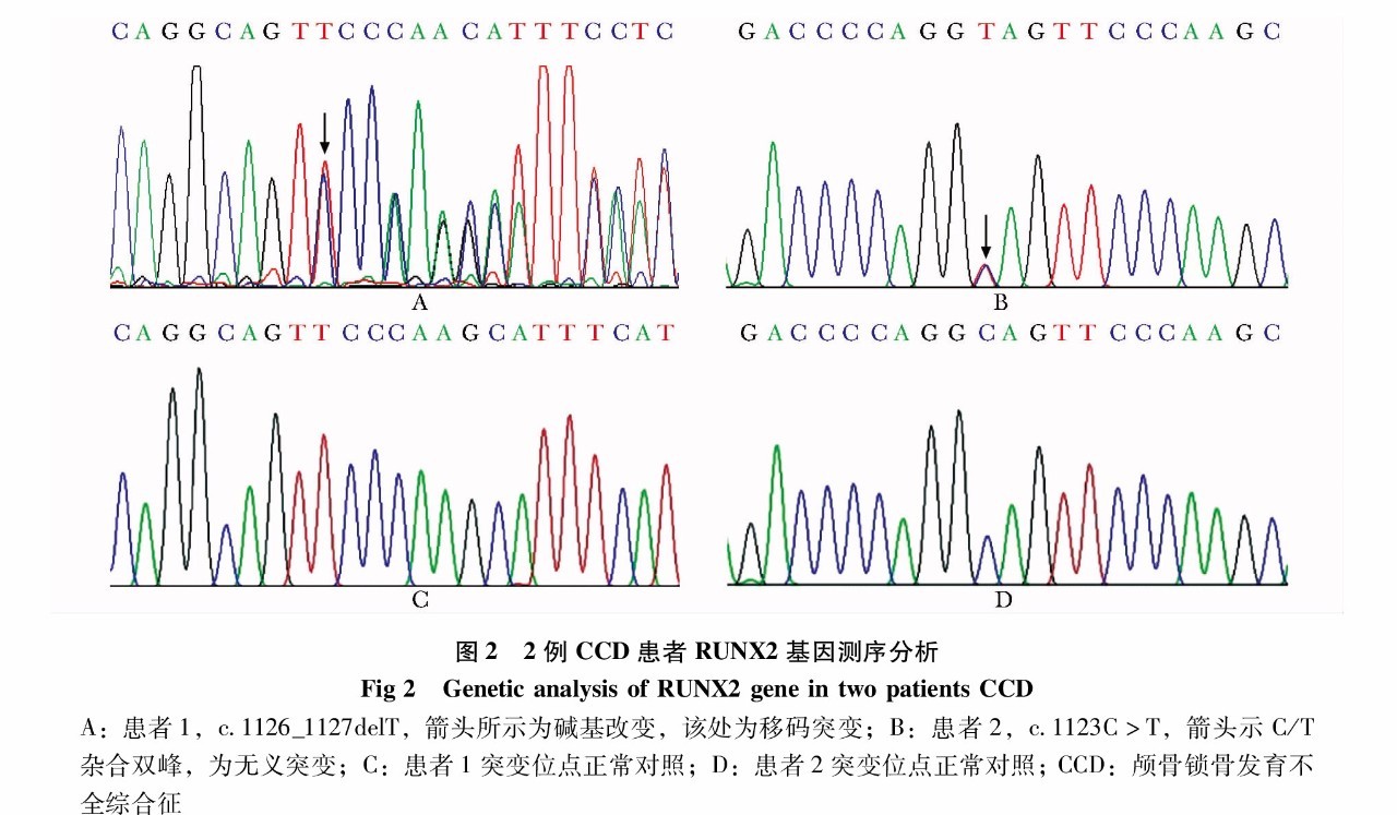 基因测序结果发现2例ccd患者均存在runx2基因杂合突变.