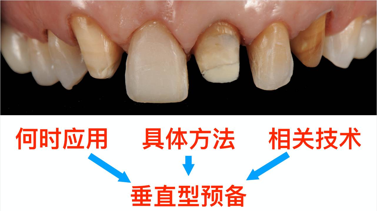 修复课】瓷贴面修复&垂直型牙体预备临床前沿技术研修班|深圳站--刘峰