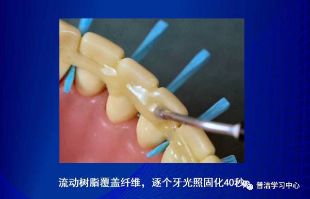 牙周夹板的分类及临床应用