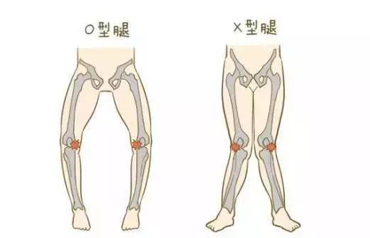缺钙和遗传是o型腿形成的两个基础,但更直接的原因,还是在于走姿