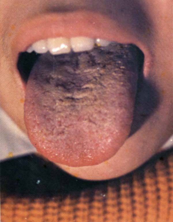 揩之不去,揩去之处的舌面多光剥无苔,称为霉苔见于口腔真菌感染的病人