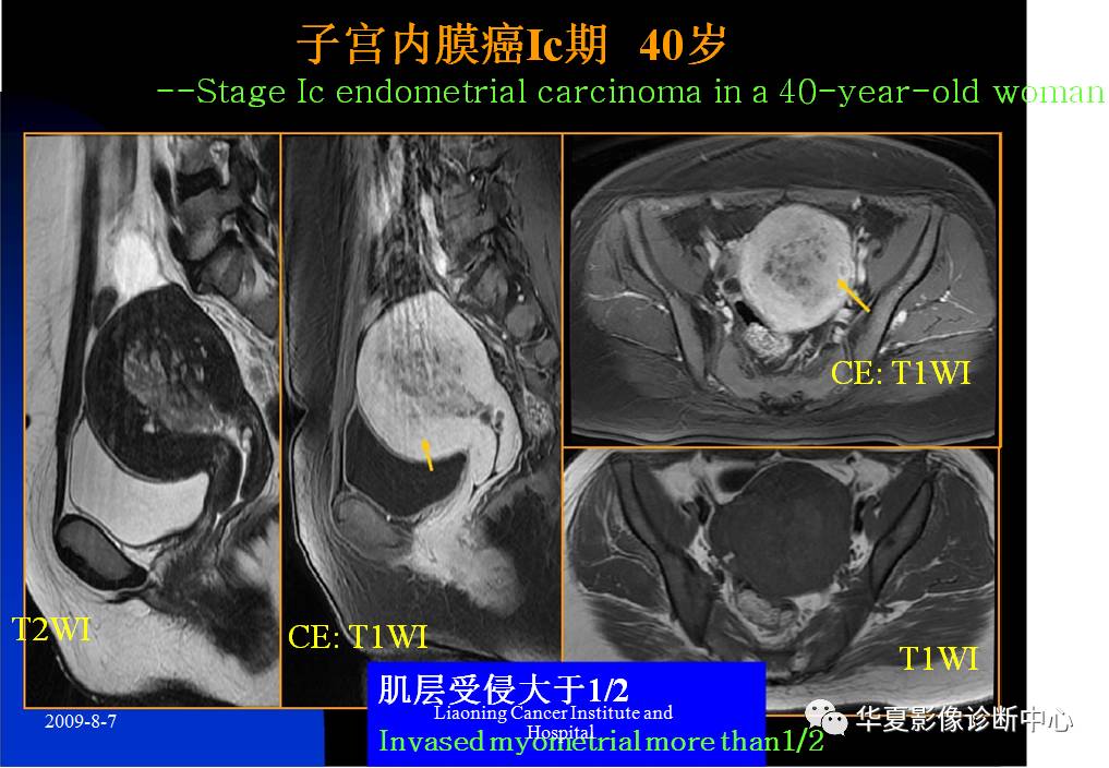 子宫恶性肿瘤的mri诊断