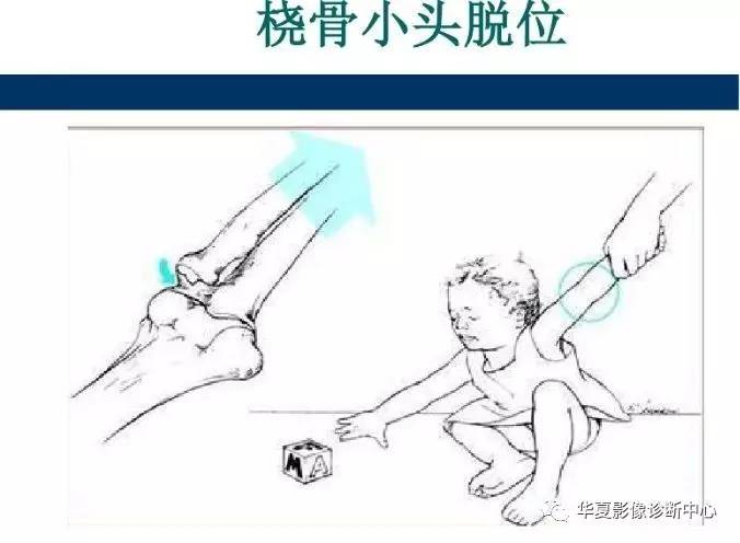 【影像基础】儿童肘关节损伤x线诊断