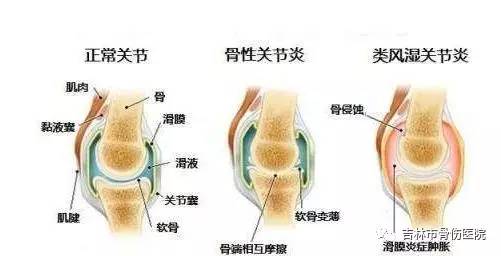 痛风性滑膜炎的症状_滑膜炎的症状_滑膜肉瘤初期症状