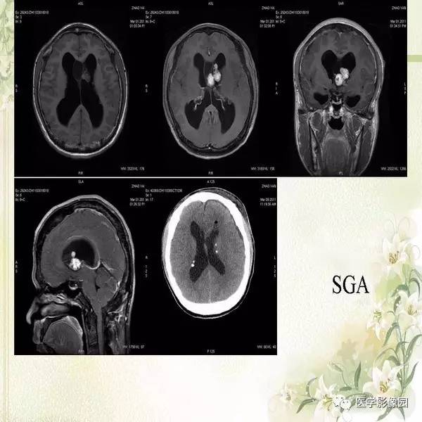 脑室肿瘤的诊断与鉴别诊断丨影像天地
