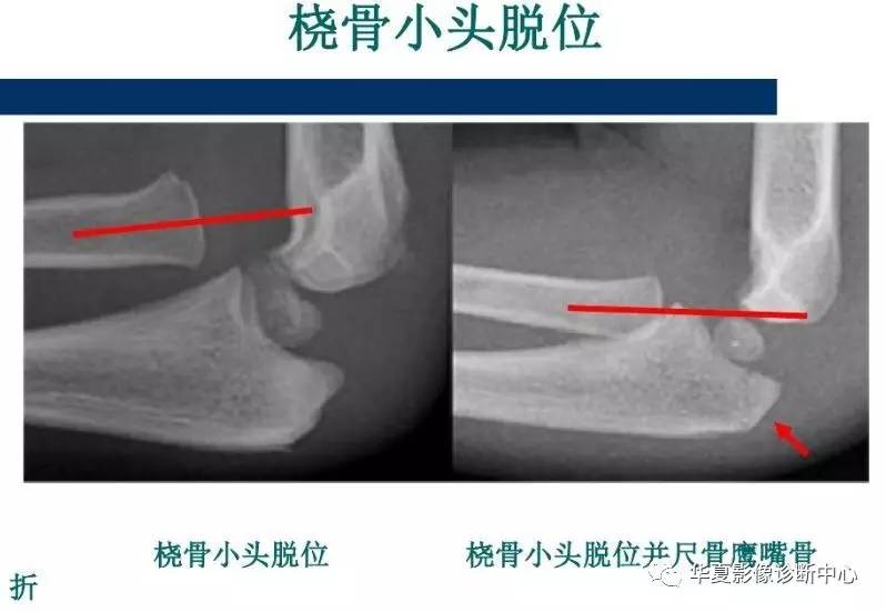 【影像基础】儿童肘关节损伤x线诊断