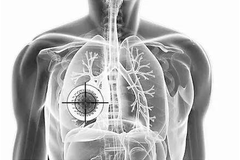 肺癌病人口苦是怎么回事_肺癌ct图片(2)