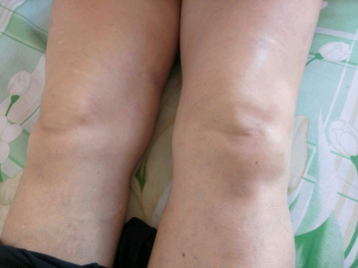 左腿膝盖肿,膝盖后面的筋疼,尤其是回弯时疼的严重!