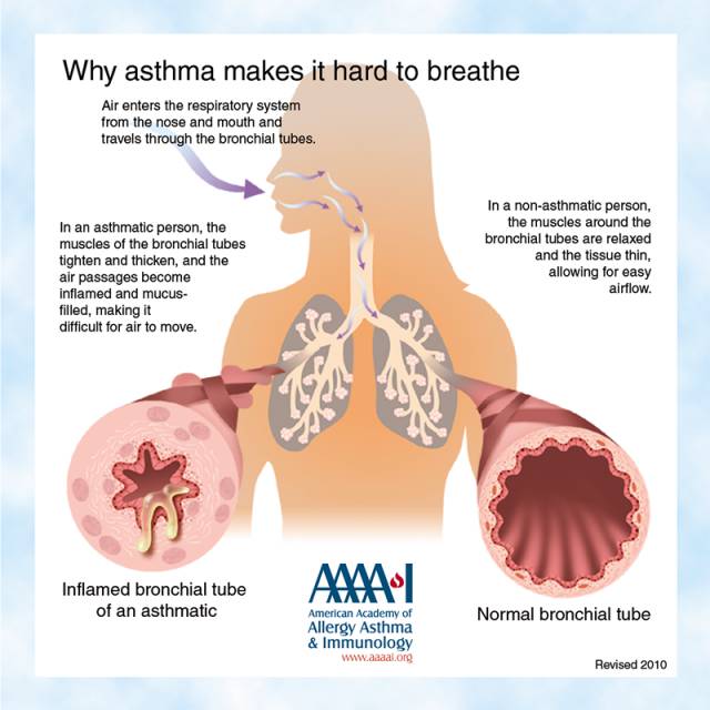 医学英语阅读anoverviewofasthma哮喘2