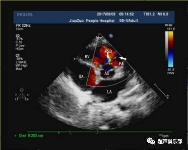 解读室间隔缺损超声影像图