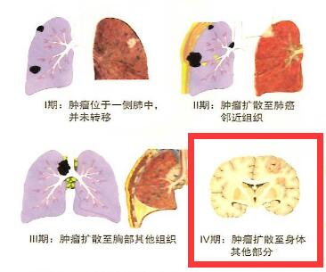 晚期(iv期)肺癌怎么治,美国临床肿瘤学会2017指南推荐