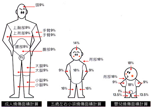 中国的医生在估算烧伤面积时多采用"九分法",即头部9%,躯干3×9%,双