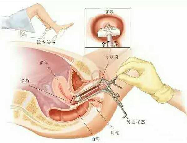 宫颈活检后出血怎么办