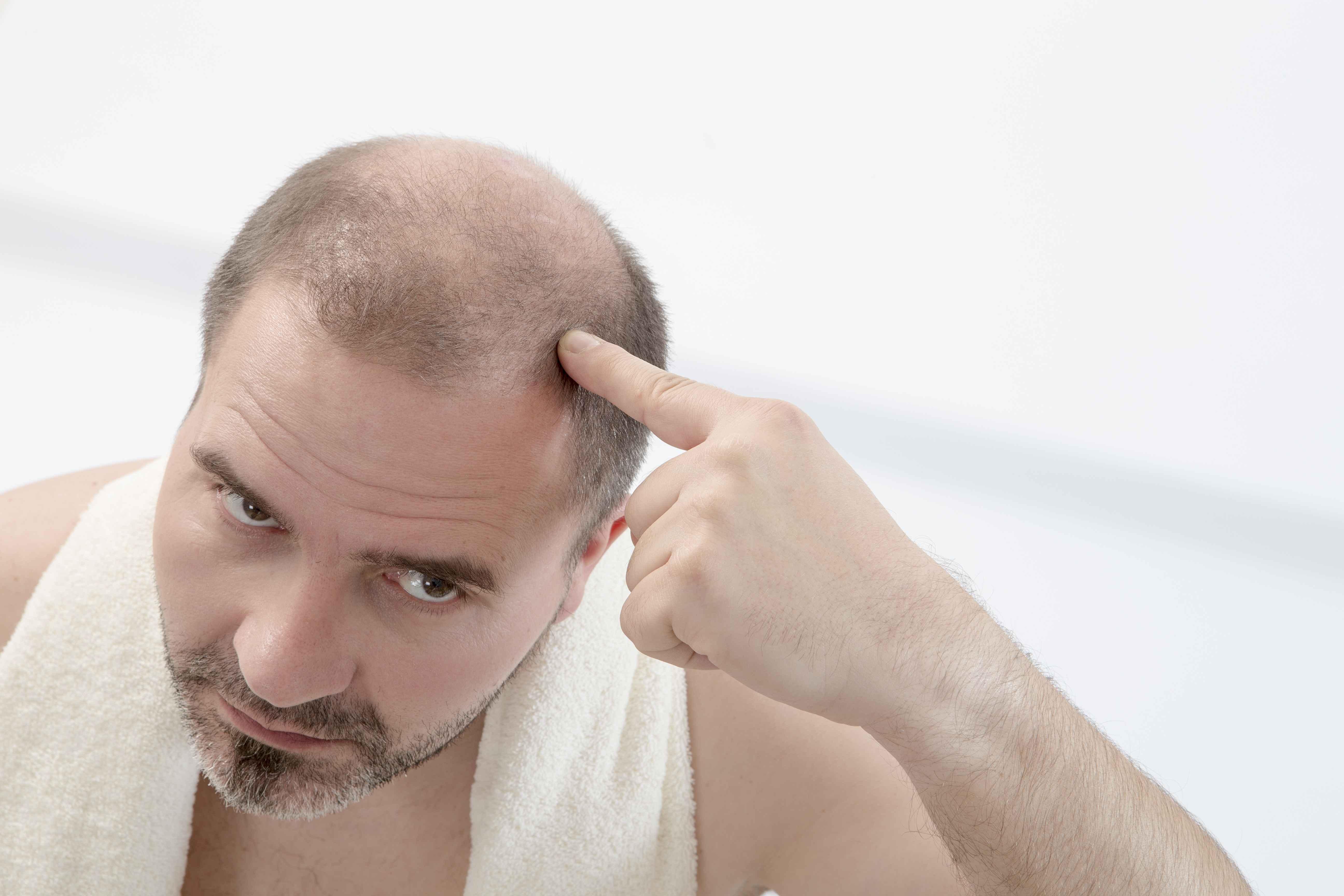 科普：脱发怎么办？严重脱发、发际线后移如何对症治疗？植发效果如何？ - 知乎