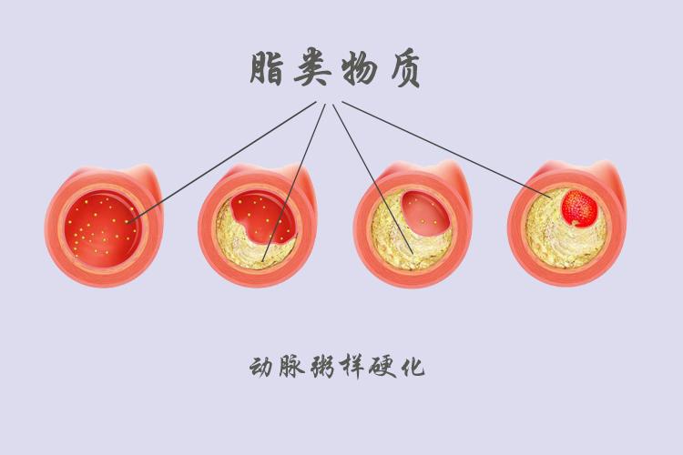 动脉粥样硬化斑块能逆转吗?怎么治疗呢?