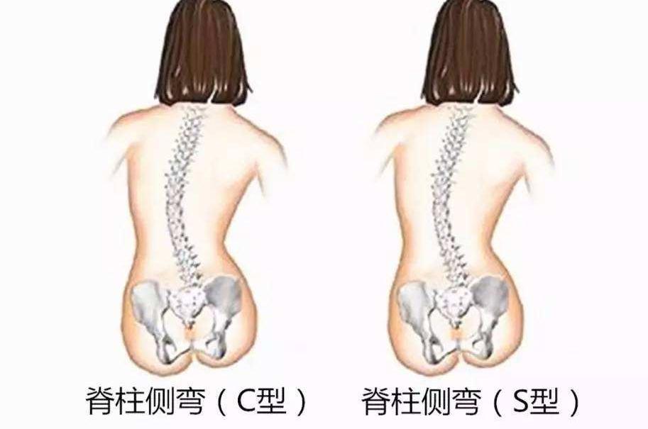 脊柱侧弯的原因及矫正方法    
