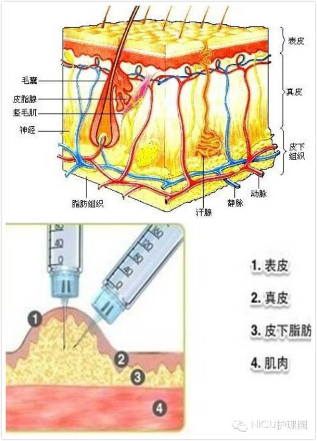 二,抗凝剂皮下注射操作 1.为什么选择皮下注射?