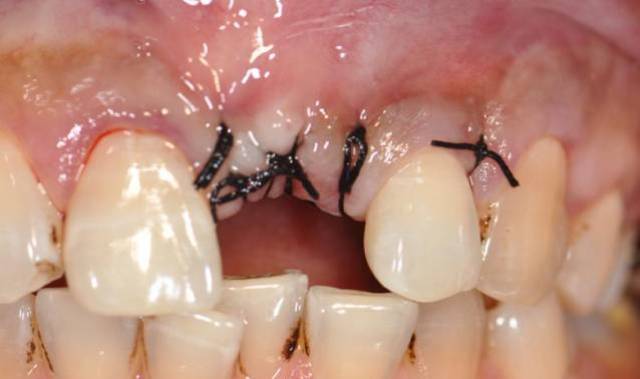 一例左上1拔牙窝保存后种植修复病例