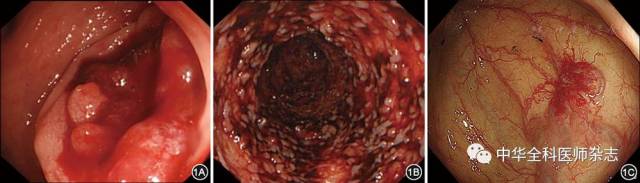 1a:结肠癌,1b:溃疡性结肠炎,1c:结肠血管畸形