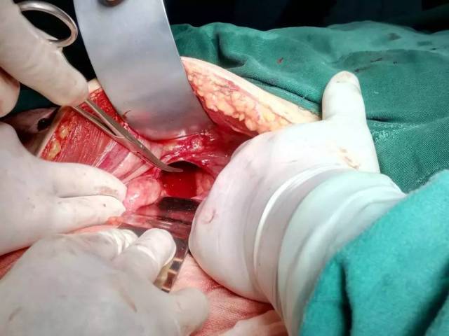 肠瘘段小肠标本,止血钳指示处为瘘口位置