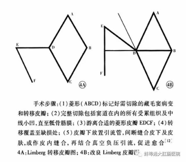 【頭條】首例藏毛竇limberg皮瓣轉移術順利完成