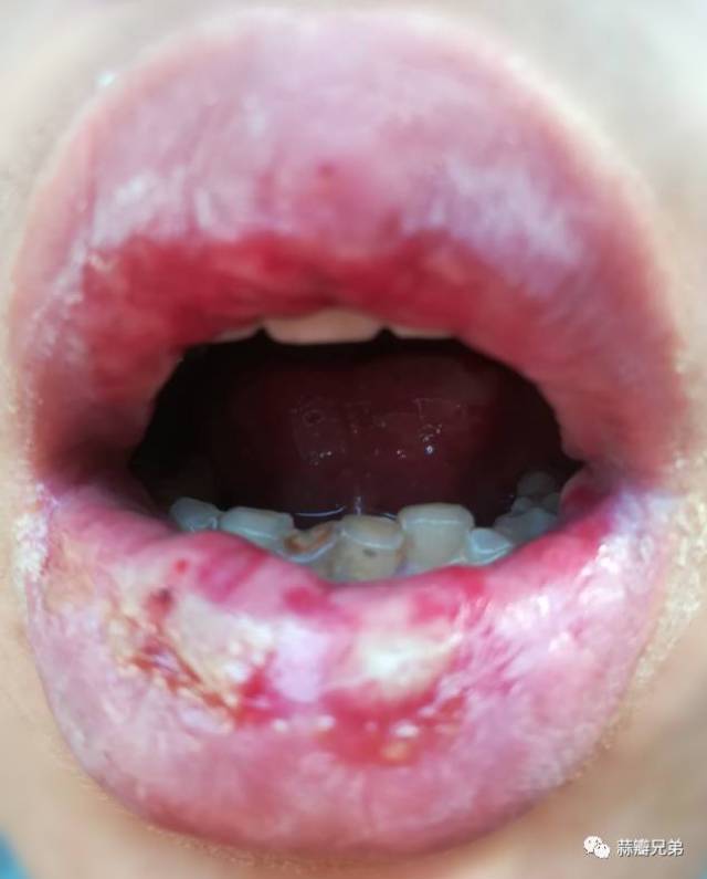 口腔溃疡菜花状图片图片
