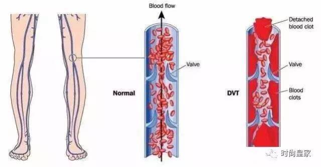 静脉血栓被称为"隐形杀手,最可怕之处就在于绝大部分的静脉血栓没有
