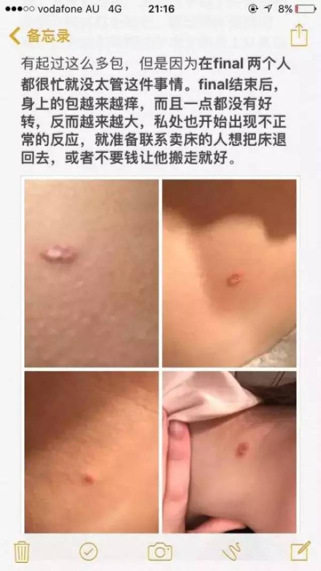 私处也被咬了!澳洲中国留学生买个床垫子,竟然遭遇臭虫!