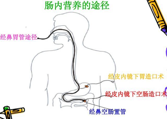 肠内营养的途径即使用胃管由鼻孔插入,经由咽部,通过食管到达胃部,由