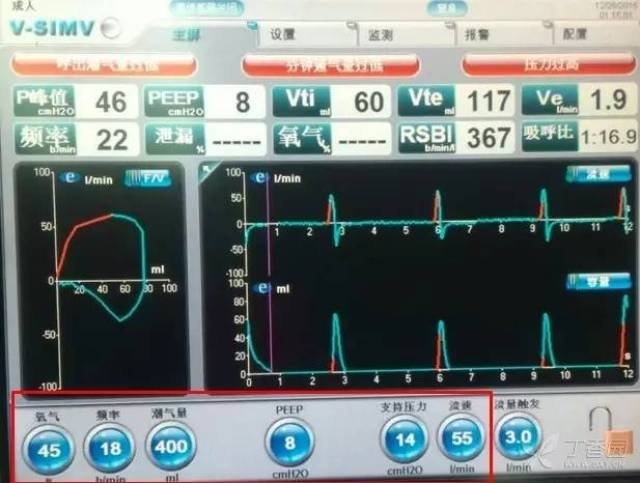 simv,其需要设定潮气量,吸气时间(峰流速,呼吸频率,同时还要设定