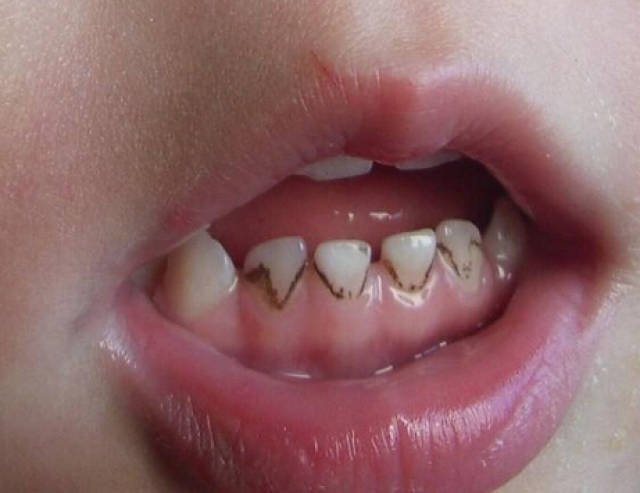孩子牙面上怎么这么多黑黑的色素