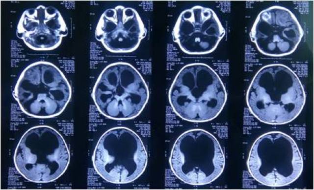 蛛网膜囊肿相关性脑积水脑室-腹腔分流术后囊肿会快速长大_手机搜狐网